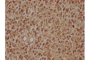 IHC image of ABIN7143497 diluted at 1:100 and staining in paraffin-embedded human glioma cancer performed on a Leica BondTM system. (ARL2BP anticorps  (AA 1-163))