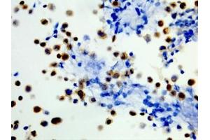 ICC staining of formalin fixed and paraffin embedded human WiDr cells (400X, Positive) with recombinant BRAF V600E antibody. (Recombinant BRAF anticorps  (Val600Glu-Mutant))