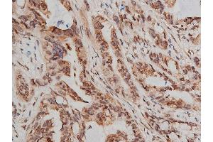 ABIN6266448 at 1/200 staining human lung cancer tissue sections by IHC-P.