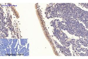 Immunohistochemical analysis of paraffin-embedded human lung cancer tissue.