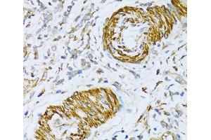 Immunohistochemistry of paraffin-embedded Human gastric cancer using VAMP1 Polyclonal Antibody at dilution of 1:100 (40x lens).
