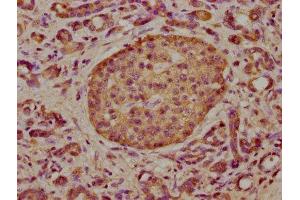 IHC image of ABIN7173590 diluted at 1:300 and staining in paraffin-embedded human pancreatic cancer performed on a Leica BondTM system. (FAM115C anticorps  (AA 472-590))