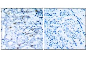Immunohistochemical analysis of paraffin-embedded human breast carcinoma tissue, using CDC2 (phospho-Thr161) antibody (E011134). (CDK1 anticorps  (pThr161))
