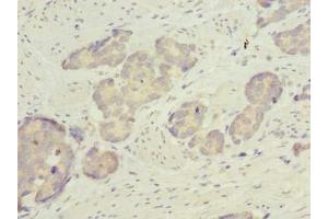 Immunohistochemistry of paraffin-embedded human gastric cancer using ABIN7158529 at dilution of 1:100 (ACSBG2 anticorps  (AA 301-600))