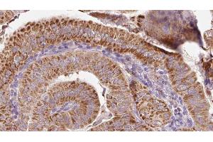 ABIN6267087 at 1/100 staining Human thyroid cancer tissue by IHC-P. (PKD2 anticorps  (pSer812))