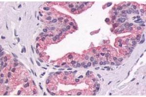 Immunohistochemical (Formalin/PFA-fixed paraffin-embedded sections) staining in human prostate, epithelium with GPR87 polyclonal antibody . (GPR87 anticorps  (Extracellular Domain))