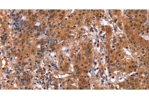 Immunohistochemistry of paraffin-embedded Human gastric cancer using GUK1 Polyclonal Antibody at dilution of 1:50 (GUK1 anticorps)