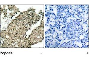 Imunohistochemical analysis of paraffin-embedded human breast carcinoma tissue, using G3BP1 (phospho S232) polyclonal antibody  (A) or preincubated with blocking peptide (B). (G3BP1 anticorps  (pSer232))