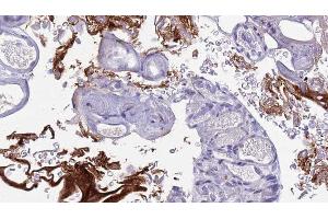 ABIN6273442 at 1/100 staining Human urothelial cancer tissue by IHC-P. (CD177 anticorps  (Internal Region))