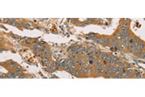 Immunohistochemistry of paraffin-embedded Human gastric cancer tissue using XPR1 Polyclonal Antibody at dilution of 1:45(x200) (xpr1 anticorps)