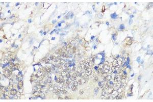 Immunohistochemistry of paraffin-embedded Human colon carcinoma using GPX2 Polyclonal Antibody at dilution of 1:100 (40x lens).