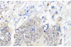 Immunohistochemistry of paraffin-embedded Human colon carcinoma using GPX2 Polyclonal Antibody at dilution of 1:100 (40x lens). (Glutathione Peroxidase 2 anticorps)