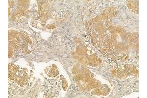 ABIN6263074 and ABIN6278147 at 1/100 staining human lung squamous cell carcinoma by IHC-P. (Melanoma Antigen Family D, 4 (MAGED4) (N-Term) anticorps)