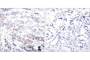 Immunohistochemistry analysis of paraffin-embedded human breast carcinoma tissue, using Elk1 (Ab-383) Antibody.