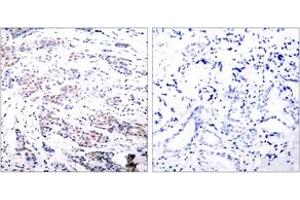 Immunohistochemistry analysis of paraffin-embedded human breast carcinoma tissue, using Elk1 (Ab-383) Antibody. (ELK1 anticorps  (AA 351-400))