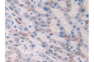 Detection of Ang1-7 in Human Liver cancer Tissue using Monoclonal Antibody to Angiotensin 1-7 (Ang1-7) (Angiotensin 1-7 anticorps)