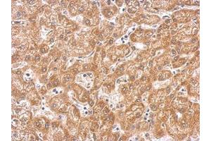 IHC-P Image PAK1 antibody detects PAK1 protein on human hepatoma by immunohistochemical analysis.