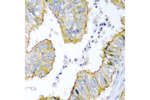 Immunohistochemistry of paraffin-embedded human colon carcinoma using KRBOX4 antibody at dilution of 1:200 (40x lens). (KRAB Box Domain Containing 4 (KRBOX4) anticorps)
