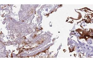 ABIN6273445 at 1/100 staining Human urothelial cancer tissue by IHC-P. (CD27 anticorps  (Internal Region))