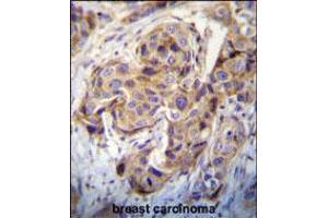 DUSP3 Antibody immunohistochemistry analysis in formalin fixed and paraffin embedded human breast carcinoma followed by peroxidase conjugation of the secondary antibody and DAB staining. (Dual Specificity Phosphatase 3 (DUSP3) (AA 157-185), (C-Term) anticorps)