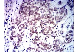 Immunohistochemical analysis of paraffin-embedded bladder cancer tissues using MLH1 mouse mAb with DAB staining.