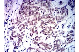 Immunohistochemical analysis of paraffin-embedded bladder cancer tissues using MLH1 mouse mAb with DAB staining. (MLH1 anticorps  (AA 381-483))