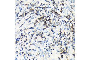 Immunohistochemistry of paraffin-embedded human lung cancer using CSK Rabbit mAb (ABIN1513217, ABIN3021034, ABIN3021035 and ABIN7101334) at dilution of 1:100 (40x lens).