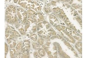 ABIN6262313 and ABIN6277241 at 1/100 staining human renal cell carcinoma by IHC-P.