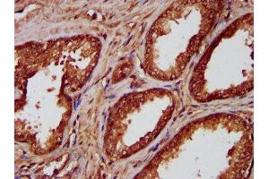 IHC image of ABIN7155827 diluted at 1:300 and staining in paraffin-embedded human prostate cancer performed on a Leica BondTM system.