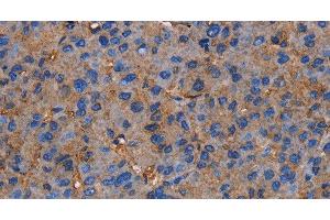 Immunohistochemistry of paraffin-embedded Human liver cancer tissue using NRIP3 Polyclonal Antibody at dilution 1:60 (NRIP3 anticorps)