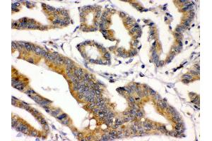 IHC(P): Human Intestinal Cancer Tissue (BMP2 anticorps  (C-Term))