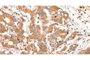 Immunohistochemistry of paraffin-embedded Human colon cancer tissue using CELSR2 Polyclonal Antibody at dilution 1:50 (CELSR2 anticorps)