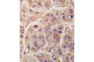 Formalin-fixed and paraffin-embedded human hepatocarcinoma tissue reacted with PIM3 antibody , which was peroxidase-conjugated to the secondary antibody, followed by DAB staining. (PIM3 anticorps  (C-Term))
