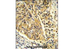 Formalin-fixed and paraffin-embedded human lung carcinoma reacted with CLTA Antibody , which was peroxidase-conjugated to the secondary antibody, followed by DAB staining. (CLTA anticorps  (AA 99-127))