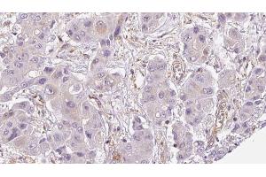 ABIN6273954 at 1/100 staining Human liver cancer tissue by IHC-P. (OR2A12 anticorps  (C-Term))