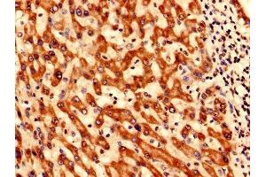 Immunohistochemistry analysis of human liver cancer using ABIN7171128 at dilution of 1:100
