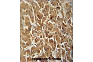 ATP5G2 antibody (C-term) (ABIN652087 and ABIN2840542) immunohistochemistry analysis in formalin fixed and paraffin embedded human hepatocarcinoma followed by peroxidase conjugation of the secondary antibody and DAB staining.