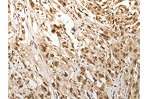 The image on the left is immunohistochemistry of paraffin-embedded Human esophagus cancer tissue using ABIN7189683(ADIPOR2 Antibody) at dilution 1/15, on the right is treated with synthetic peptide. (Adiponectin Receptor 2 anticorps)