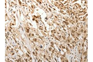 The image on the left is immunohistochemistry of paraffin-embedded Human esophagus cancer tissue using ABIN7189683(ADIPOR2 Antibody) at dilution 1/15, on the right is treated with synthetic peptide. (Adiponectin Receptor 2 anticorps)