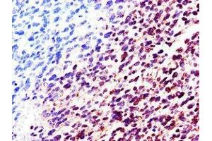 Immunohistochemistry of paraffin-embedded human glioma using ABIN7157858 at dilution of 1:100 (Lamin B2 anticorps  (AA 442-615))