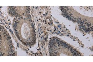 Immunohistochemistry of paraffin-embedded Human colon cancer using HIST1H2AH Polyclonal Antibody at dilution of 1:40 (HIST1H2AH anticorps)