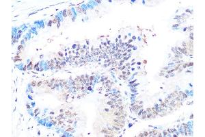Immunohistochemistry of paraffin-embedded human colon carcinoma using Casein Kinase 2 beta (CSNK2B) (CSNK2B) Rabbit mAb (ABIN1680593, ABIN3019007, ABIN3019008 and ABIN7101698) at dilution of 1:100 (40x lens).