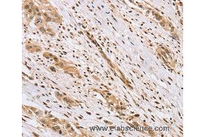 Immunohistochemistry of Human esophagus cancer using CENPV Polyclonal Antibody at dilution of 1:40 (CENPV anticorps)