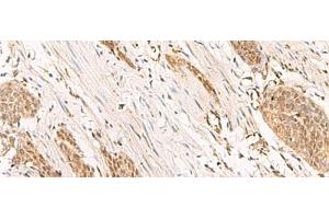 Immunohistochemistry of paraffin-embedded Human esophagus cancer tissue using POP4 Polyclonal Antibody at dilution of 1:65(x200) (RPP29 anticorps)