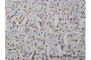 Immunoperoxidase of monoclonal antibody to RNF168 on formalin-fixed paraffin-embedded human prostate cancer.