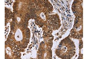The image on the left is immunohistochemistry of paraffin-embedded Human colon cancer tissue using ABIN7129394(ERCC6L Antibody) at dilution 1/30, on the right is treated with fusion protein. (ERCC6L anticorps)