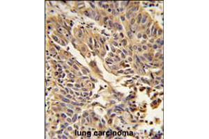 Formalin-fixed and paraffin-embedded human lung carcinoma reacted with JUP Antibody , which was peroxidase-conjugated to the secondary antibody, followed by DAB staining. (JUP anticorps  (C-Term))