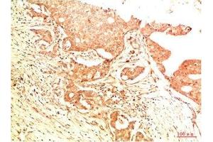 Immunohistochemical analysis of paraffin-embedded Human Breast Carcinoma Tissue using Acetyl P53(K382) Mouse mAb diluted at 1:200.