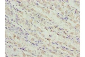 Immunohistochemistry of paraffin-embedded human gastric cancer using ABIN7173119 at dilution of 1:100 (TMEM19 anticorps  (AA 105-217))