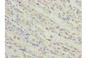 Immunohistochemistry of paraffin-embedded human gastric cancer using ABIN7173119 at dilution of 1:100